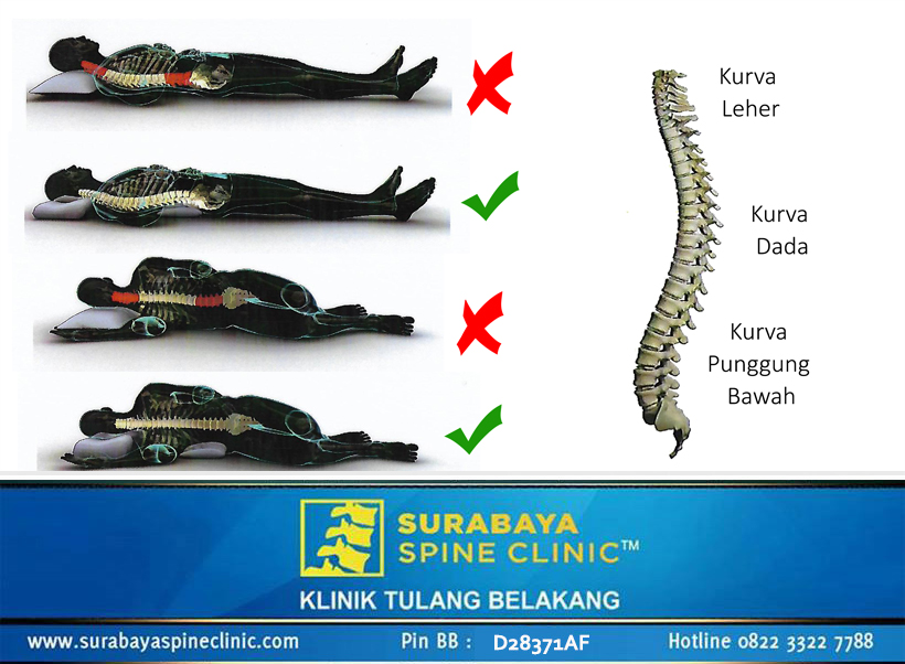Bantal dan Risiko Nyeri Punggung